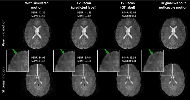 Figure 3 for Deep Learning-Based Detection of Motion-Affected k-Space Lines for T2*-Weighted MRI
