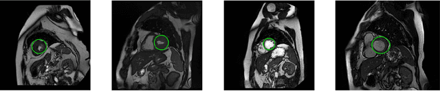 Figure 1 for Automatic Segmentation of Left Ventricle in Cardiac Magnetic Resonance Images