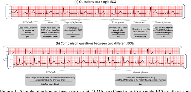 Figure 1 for ECG-QA: A Comprehensive Question Answering Dataset Combined With Electrocardiogram
