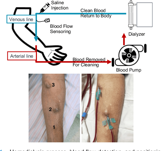 Figure 1 for Deep denoising autoencoder-based non-invasive blood flow detection for arteriovenous fistula