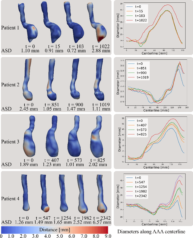 Figure 4 for Implicit Neural Representations for Modeling of Abdominal Aortic Aneurysm Progression