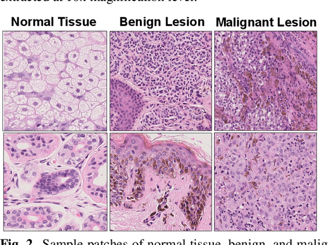 Figure 3 for Detection and Localization of Melanoma Skin Cancer in Histopathological Whole Slide Images