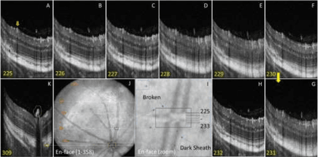 Figure 3 for AI pipeline for accurate retinal layer segmentation using OCT 3D images