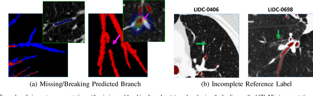 Figure 1 for Accurate Airway Tree Segmentation in CT Scans via Anatomy-aware Multi-class Segmentation and Topology-guided Iterative Learning
