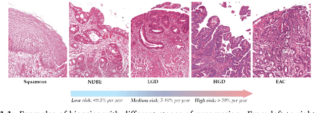 Figure 1 for Geometry-Aware Latent Representation Learning for Modeling Disease Progression of Barrett's Esophagus