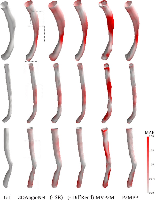 Figure 4 for 3D Coronary Vessel Reconstruction from Bi-Plane Angiography using Graph Convolutional Networks