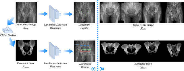Figure 1 for PELE scores: Pelvic X-ray Landmark Detection by Pelvis Extraction and Enhancement