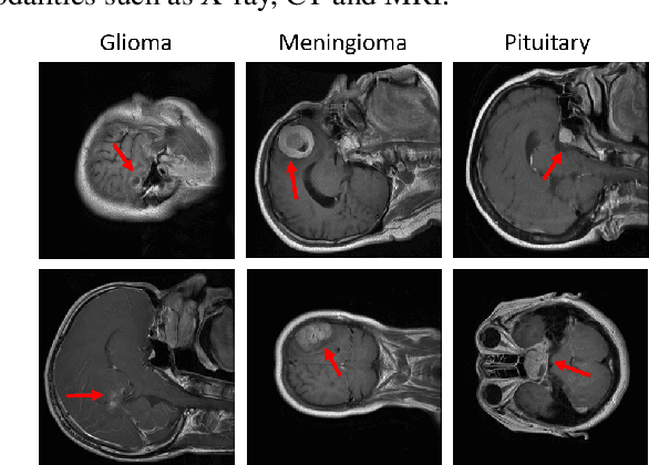 Figure 1 for An L2-Normalized Spatial Attention Network For Accurate And Fast Classification Of Brain Tumors In 2D T1-Weighted CE-MRI Images