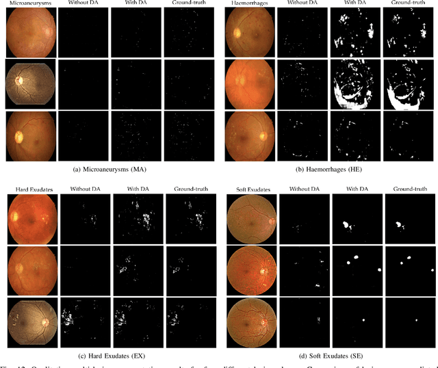 Figure 4 for DRG-Net: Interactive Joint Learning of Multi-lesion Segmentation and Classification for Diabetic Retinopathy Grading