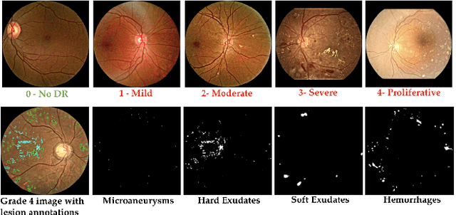Figure 1 for DRG-Net: Interactive Joint Learning of Multi-lesion Segmentation and Classification for Diabetic Retinopathy Grading