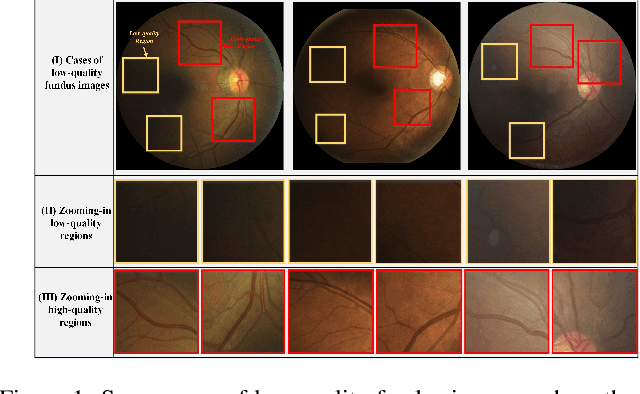 Figure 1 for Self-supervised Domain Adaptation for Breaking the Limits of Low-quality Fundus Image Quality Enhancement