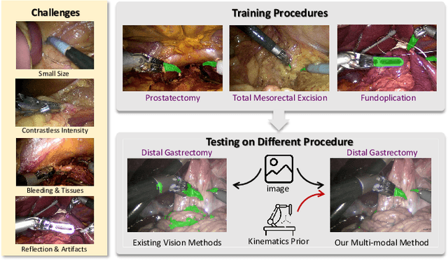 Figure 1 for Visual-Kinematics Graph Learning for Procedure-agnostic Instrument Tip Segmentation in Robotic Surgeries