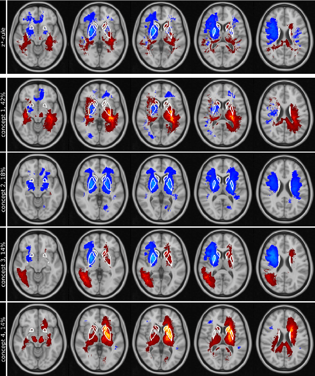 Figure 3 for Explainable concept mappings of MRI: Revealing the mechanisms underlying deep learning-based brain disease classification