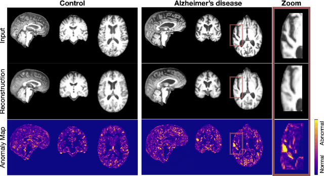 Figure 2 for Bias in Unsupervised Anomaly Detection in Brain MRI