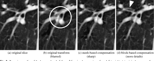 Figure 3 for Analysis of displacement compensation methods for wavelet lifting of medical 3-D thorax CT volume data