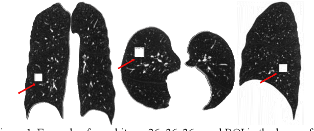 Figure 1 for Robust deep labeling of radiological emphysema subtypes using squeeze and excitation convolutional neural networks: The MESA Lung and SPIROMICS Studies