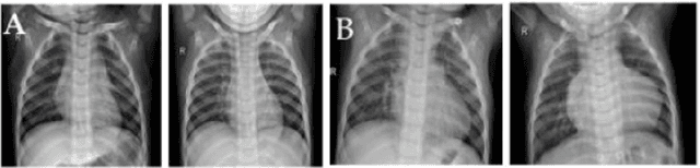 Figure 1 for Pneumonia Detection in Chest X-Ray Images : Handling Class Imbalance