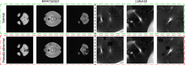 Figure 2 for Masked Autoencoders for Unsupervised Anomaly Detection in Medical Images