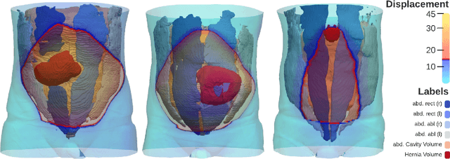 Figure 2 for HEDI: First-Time Clinical Application and Results of a Biomechanical Evaluation and Visualisation Tool for Incisional Hernia Repair