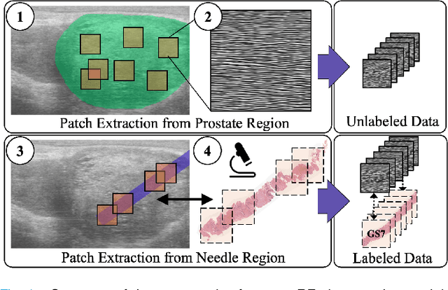 Figure 1 for Self-Supervised Learning with Limited Labeled Data for Prostate Cancer Detection in High Frequency Ultrasound