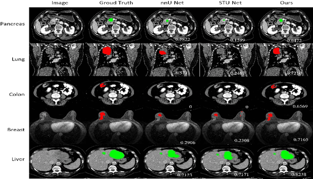 Figure 3 for A Segmentation Foundation Model for Diverse-type Tumors