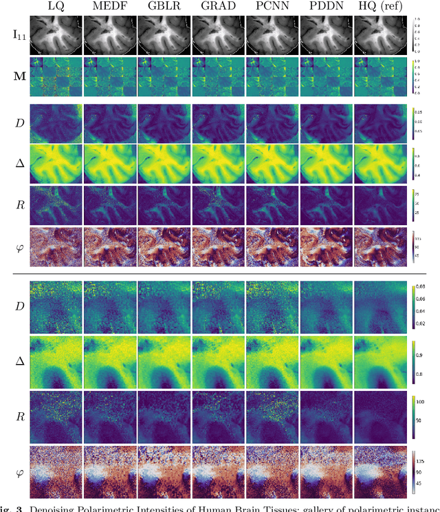 Figure 4 for Near-Real-Time Mueller Polarimetric Image Processing for Neurosurgical Intervention