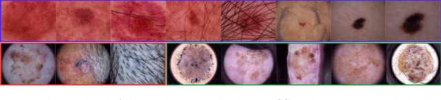 Figure 4 for Revisiting Skin Tone Fairness in Dermatological Lesion Classification