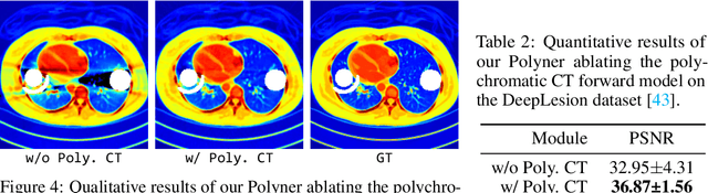 Figure 4 for Unsupervised Polychromatic Neural Representation for CT Metal Artifact Reduction