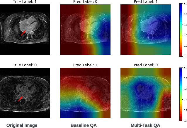 Figure 3 for Two-Stage Deep Learning Framework for Quality Assessment of Left Atrial Late Gadolinium Enhanced MRI Images