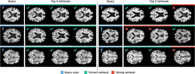 Figure 4 for DeepBrainPrint: A Novel Contrastive Framework for Brain MRI Re-Identification