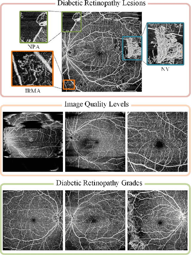 Figure 1 for DRAC: Diabetic Retinopathy Analysis Challenge with Ultra-Wide Optical Coherence Tomography Angiography Images