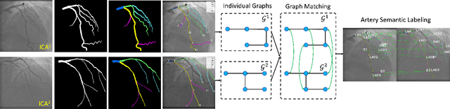 Figure 1 for Hyper Association Graph Matching with Uncertainty Quantification for Coronary Artery Semantic Labeling