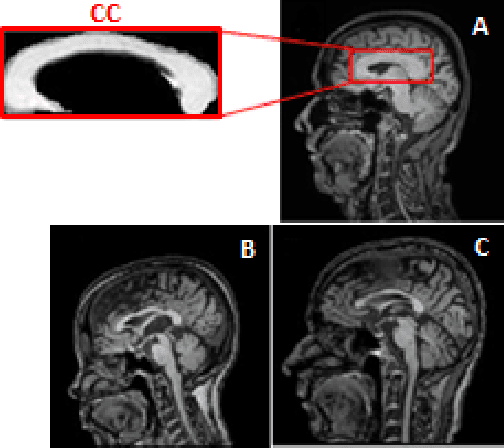 Figure 2 for Interpretable simultaneous localization of MRI corpus callosum and classification of atypical Parkinsonian disorders using YOLOv5