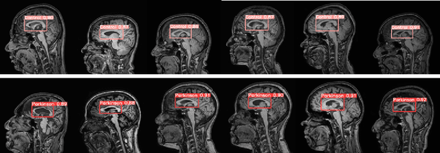 Figure 3 for Interpretable simultaneous localization of MRI corpus callosum and classification of atypical Parkinsonian disorders using YOLOv5
