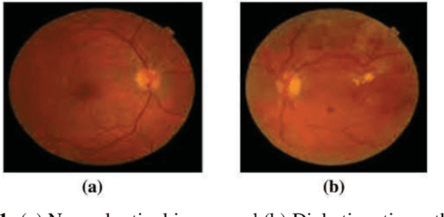 Figure 1 for Strategy for Rapid Diabetic Retinopathy Exposure Based on Enhanced Feature Extraction Processing