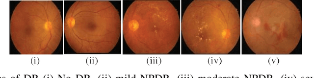 Figure 4 for Strategy for Rapid Diabetic Retinopathy Exposure Based on Enhanced Feature Extraction Processing