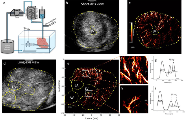 Figure 2 for Transthoracic super-resolution ultrasound localization microscopy of myocardial vasculature in patients