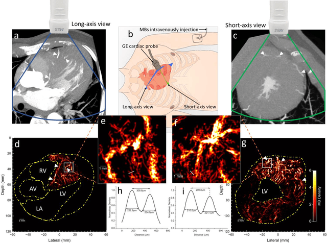 Figure 3 for Transthoracic super-resolution ultrasound localization microscopy of myocardial vasculature in patients