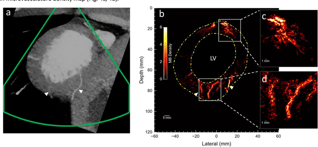 Figure 4 for Transthoracic super-resolution ultrasound localization microscopy of myocardial vasculature in patients