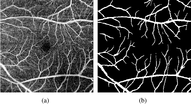 Figure 1 for An Accurate and Efficient Neural Network for OCTA Vessel Segmentation and a New Dataset