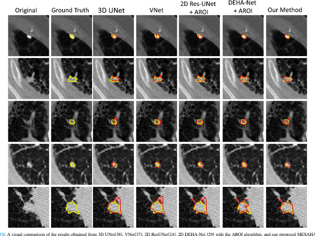 Figure 2 for MESAHA-Net: Multi-Encoders based Self-Adaptive Hard Attention Network with Maximum Intensity Projections for Lung Nodule Segmentation in CT Scan
