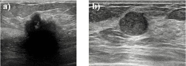 Figure 1 for Deep meta-learning for the selection of accurate ultrasound based breast mass classifier