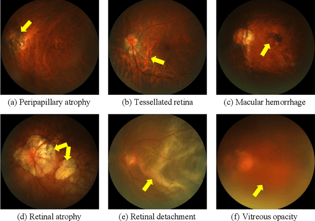 Figure 1 for PALM: Open Fundus Photograph Dataset with Pathologic Myopia Recognition and Anatomical Structure Annotation