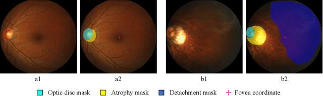 Figure 4 for PALM: Open Fundus Photograph Dataset with Pathologic Myopia Recognition and Anatomical Structure Annotation