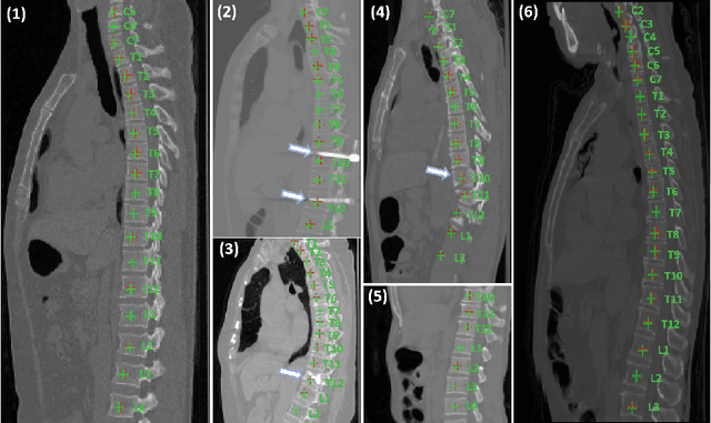 Figure 4 for Multi-View Vertebra Localization and Identification from CT Images