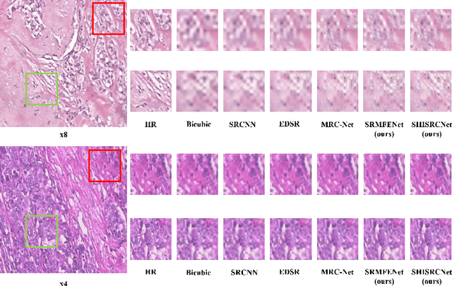 Figure 3 for SHISRCNet: Super-resolution And Classification Network For Low-resolution Breast Cancer Histopathology Image