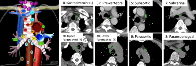 Figure 1 for Anatomy-Aware Lymph Node Detection in Chest CT using Implicit Station Stratification