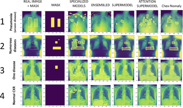 Figure 3 for CheX-Nomaly: Segmenting Lung Abnormalities from Chest Radiographs using Machine Learning