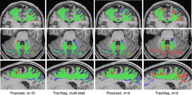 Figure 4 for Direct segmentation of brain white matter tracts in diffusion MRI