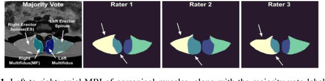 Figure 1 for How inter-rater variability relates to aleatoric and epistemic uncertainty: a case study with deep learning-based paraspinal muscle segmentation